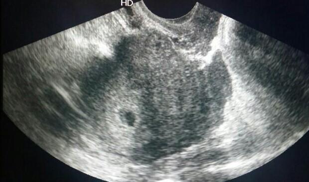 Figure 3: Intrauterine gestational sac and mild free fluid in the pelvis. Management: Patient was taken up for an emergency laprotomy and a note of left sided tubal abortion was made with a gravid uterus. The right tube and ovary werenormal. Hemoperitonem of around 200 cc was present along with some old clots. The left tube was densely adherent to the bowel. Left salpingectomy was done after minimal adhesiolysis. Patient remained stable in the post operative period.