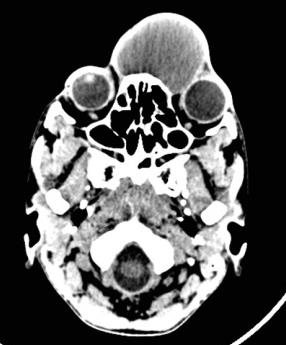 Figure 2: TDM axial section showing a large left frontal mass, homogeneous hypodense blowing the bone walls.