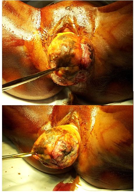Figure 1: Utero vaginal prolapse with ulcer at the time of surgery.