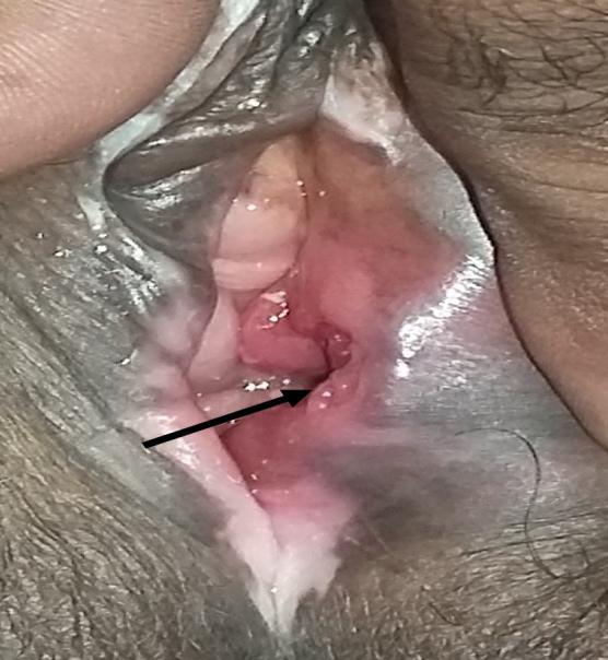 Figure 2: Lesion developed five years after initial therapy.