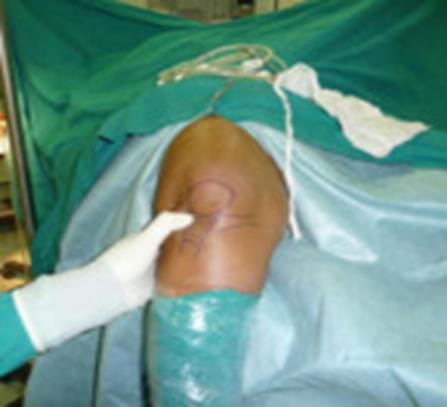 Figure 2: Radiosynovectomy preparation and technique.