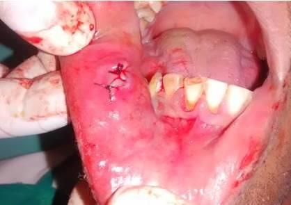 Figure 4: Lesional site sutured.