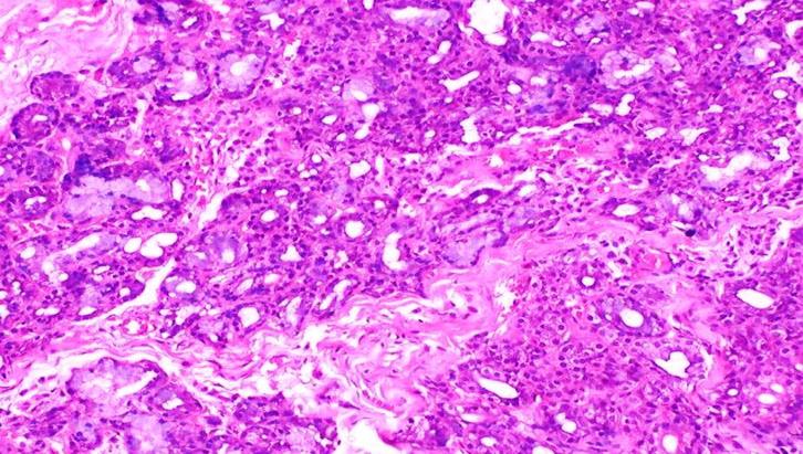 Figure 6: Histopathological examination with H & E stained section revealing granulation tissue with proliferating and engorged blood vessels interspersed with chronic inflammatory cells and with abundance of mucinophages.