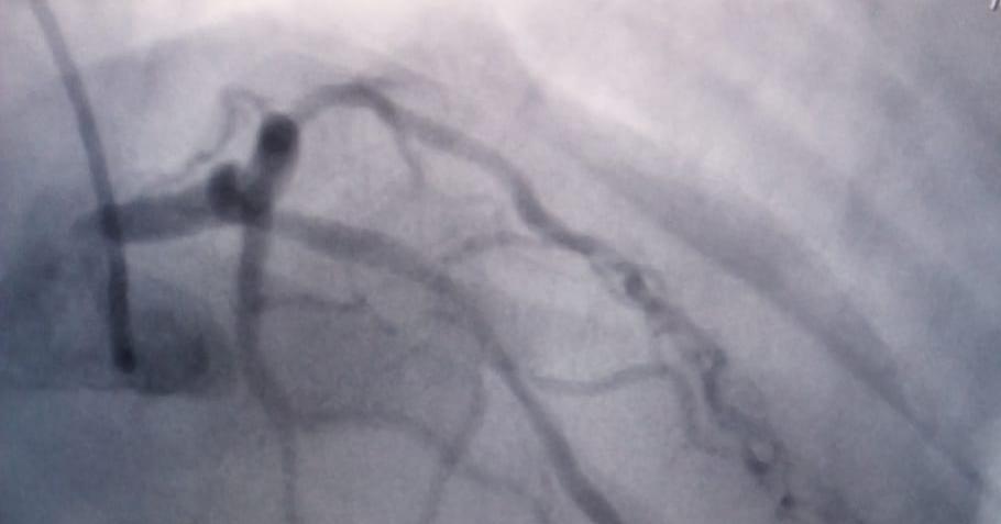 Figure 1: Coronary angiogram showing LAD mid segment 70% stenosis.