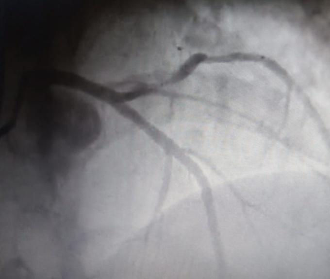 Figure 2: Coronary angiogram showing regression of LAD lesion with residual 20% stenosis.