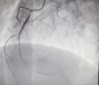 Figure 3: Coronary angiogram showing RCA proximal plaquing followed by mid to distal diffuse 95% lesion with thrombus & spontaneous spiral dissection.