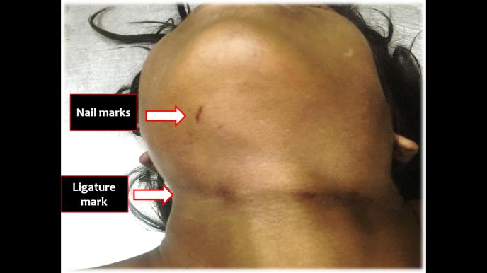 Figure 1: Dead body of a 12 year old female child with a ligature mark present obliquely around the neck and situated above the thyroid cartilage, suggestive of hanging. Two crescentric nail mark abrasions were present above the ligature mark which created a confusing picture of sexual assault.
