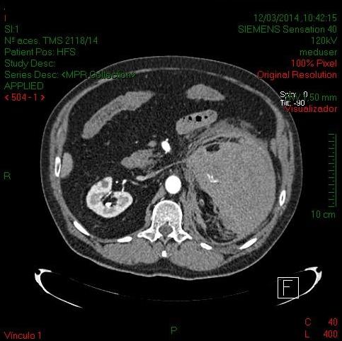 Figure 1: CT abdomen in axial section with venous contrast showing a large left retroperitoneal hematoma.