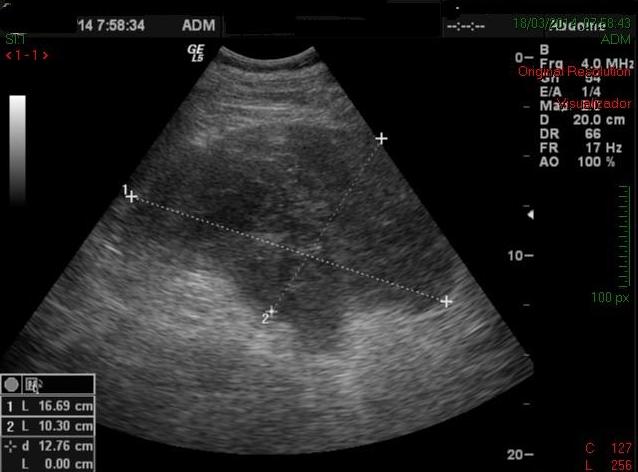 Figure 3: Initial abdominal ultrasonography.