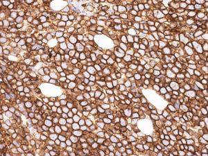 Figure 11: Burkitt's Lymphoma- Immune reactive for CD10.