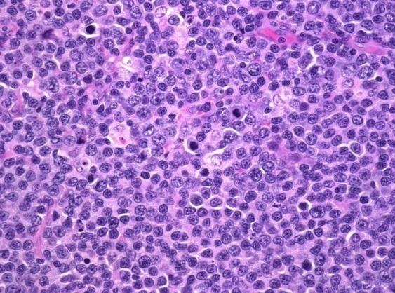 Figure 2: Burkitt's Lymphoma- tingible body macrophages.