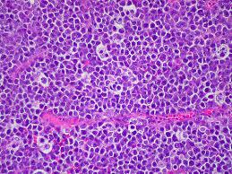 Figure 3: Burkitt's Lymphoma-starry sky pattern.