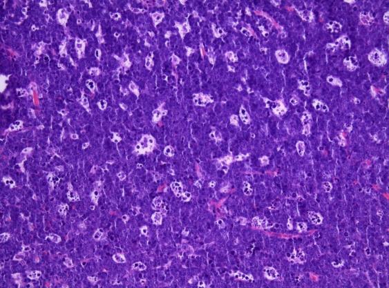 Figure 4: Burkitt's Lymphoma- monotonous, round cells with paraprotein.