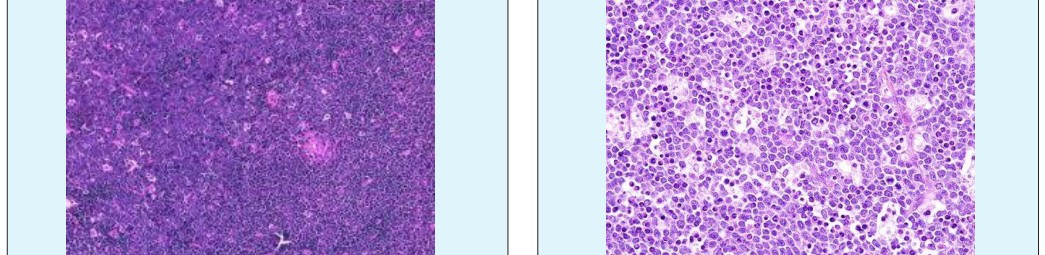 Figure 6: Burkitt's Lymphoma –prominent starry sky pattern with cellular uniformity.