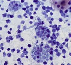 Figure 7: Burkitt's Lymphoma with tingible body aggregates.