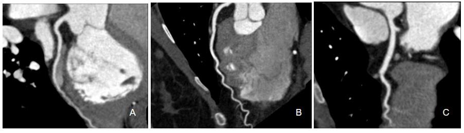 Figure 3: CCT performed a year after the event. A) CX without lesion due to a spontaneous sealing of the dissection. B & C) DCA and first diagonal branch respectively without lesion.