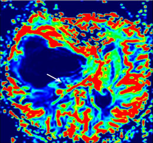 Figure 4: rCBV cartography: perfusion imaging shoed a decrease in relative cerebral blood volume (rCBV= 0,8) in the nodular part (arrow).