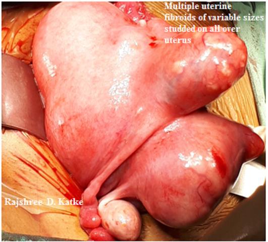 Figure 3: Multiple uterine fibroids of variable sizes studded on all over uterus.