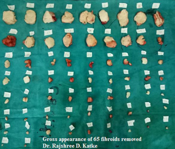 Figure 4: Gross appearance of 65 fibroids removed.