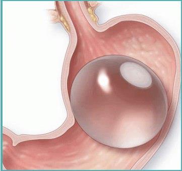 Figure 5: Intragastric Balloon (Transdermal view).