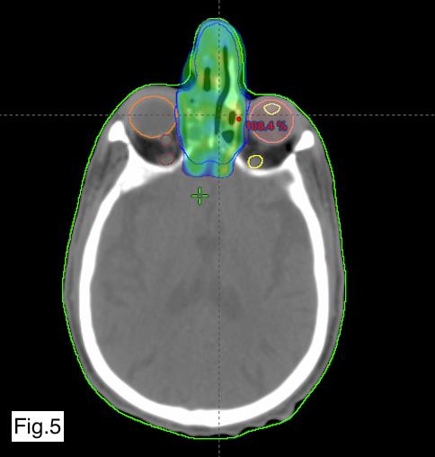 Figure 5: Axial view of the conformity of the prescribed dose to the target volume in blue and the respect of the optic nerves and eyeballs.