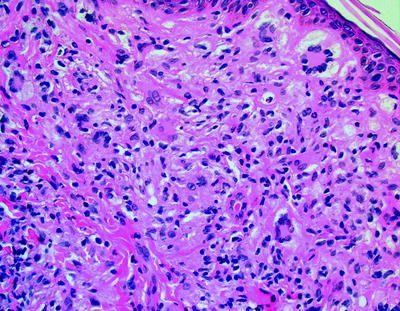 Figure 4: Primary histolytic sarcoma with vesicular nuclei and prominent nucleoli.