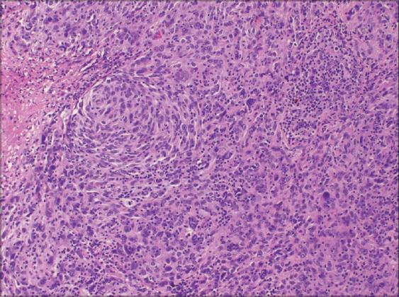 Figure 5: Neoplasm of the accessory immune system with dendritic and histiocytic cells.