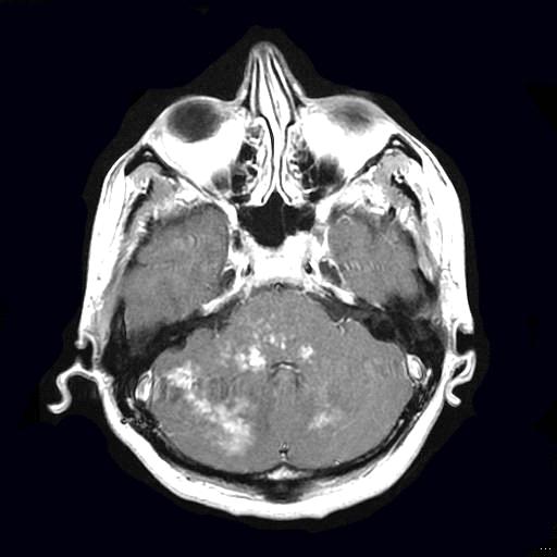 Figure 4: Typical contrast agent uptake in pons, at T1W coronal images.