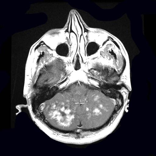 Figure 6: Typical contrast agent uptake in pons and cerebellum (Axial MR images).