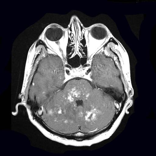 Figure 8: Typical contrast agent uptake in pons and cerebellum at T1W axial images.