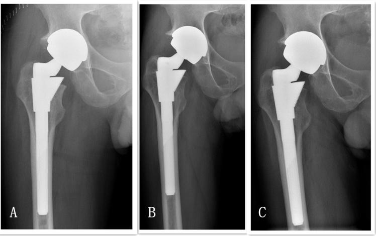 Figure 1: (A) Immediate postoperative anteroposterior radiograph of hip with the original diagnosis of osteonecrosis. (B) Radiograph of the same patient 1 year after operation when hip pain began to be noted. (C) Radiograph at the final follow-up showed no signs of asceptic loosening.