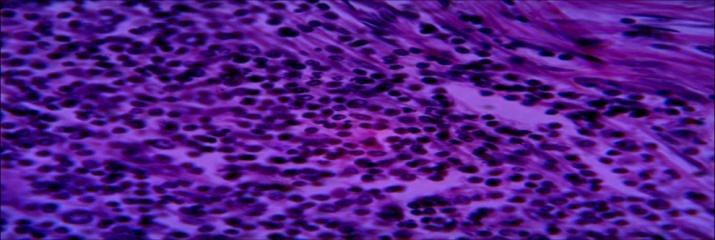 Figure 10: Section of specimen (4) lung tissue Microscopy: section show lung tissue with wall composed of inflammatory granulation tissue. Microscopy: section show lung tissue with wall composed of inflammatory granulation tissue with suppuration. NO hydatid cyst.