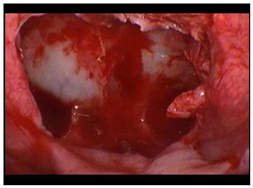 Figure 1: Endoscopic view of the sella after removing the intersphenoidal septae, with preservation of both middle and superior turbinates on both sides and making rescue flaps on both sides.