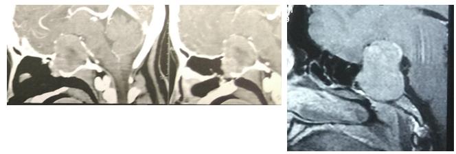 Figure 2: CT soft tissue sagittal cuts revealed a sellar lesion extending and filling the sphenoid sinus, MRI of the same case.