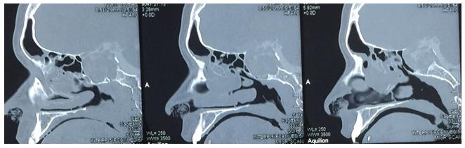 Figure 3: Computerized tomography sagittal cuts of a case of adrenocorticotropic hormone– secreting macroadenoma associated with sinonasal polyposis.