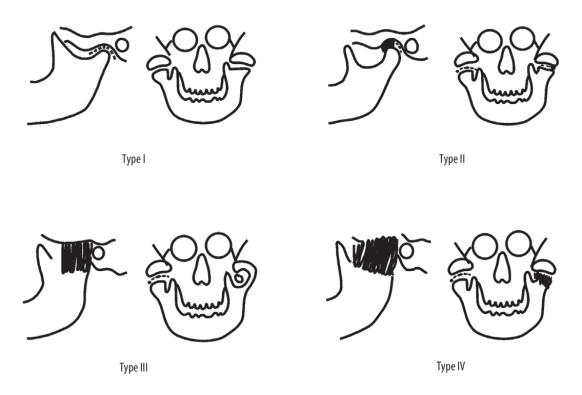 Figure 1: Ranking Sawnhey by Turlington and Durr.