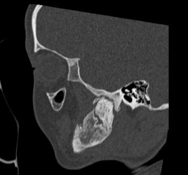 Figure 12: Tomographic after reinstalled the distractor, correct midline.