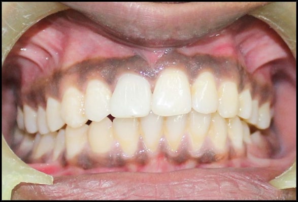 Figure 2: Application of 810 nm Diode laser in maxillary arch.