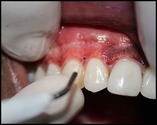 Figure 4: 01-month Post-op evaluation.