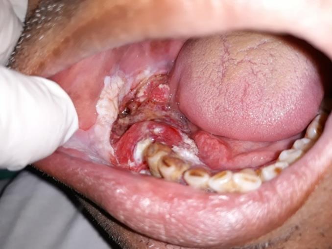 Figure 3: Intraoral image showing ulceroproliferative growth over edentulous ridge and cracked mud appearance of white patch over buccal mucosa.