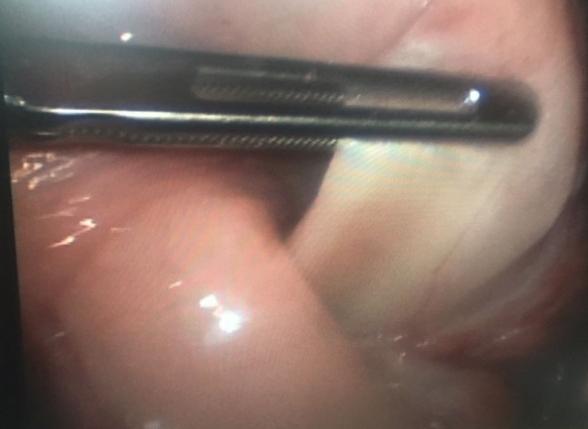 Figure 2: Exploratory laparoscopy, identifying the stomach completely intussuscepted in the duodenum.