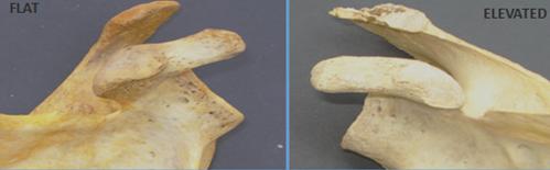 Figure 2: Image showing different shapes of faceted apophysis.