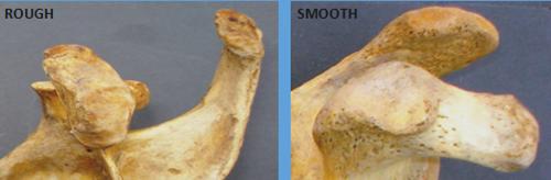 Figure 3: Image showing types of surface projection of articular facet.