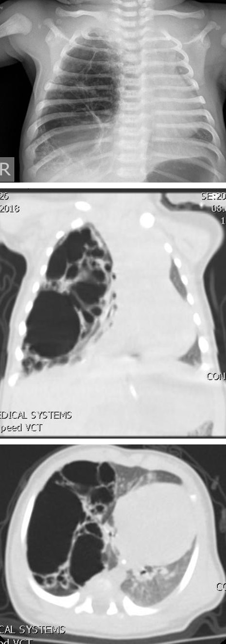 Figure 1: X ray chest - right right side with multiple cystic changes.