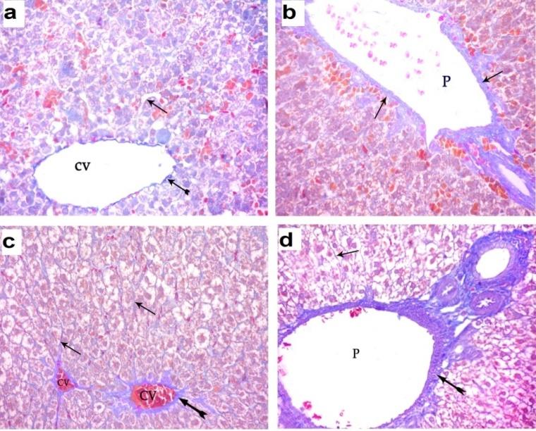 Figure 5: A photomicrograph of a liver section of ACR- treated groups: (a) D1ACR showing dilated congested central vein (cv), dilated congested blood sinusoids(s), abnormal hepatocytes (h) with vacuolated cytoplasm (v). Multiple erythroid islands (e) with intense hyperchromatic nuclei are noticed. (b) D1ACR showing dilated portal vein (p), abnormal hepatocytes (h) with vacuolated cytoplasm (v, multiple inflammatory cellular infiltration in the portal area (I), proliferated bile duct (bd) and multiple erythroid islands (e). (c) D21ACR showing dilated central vein (cv) with discontinuity of its endothelial lining (arrow), abnormally ballooned hepatocytes (h) with dark nuclei and vacuolated cytoplasm (v). (d) D21ACR showing dilated congested portal vein (p) with thickened endothelial lining (arrow), thickened hepatic artery (a), proliferated bile duct (bd), abnormal hepatocytes (h) with small dark stained nuclei and vacuolated cytoplasm (v). (H&E X400). **Mallory Staining:** Mallory-stained sections of D1ACR subgroup showed excess deposited collagen fibers around the central veins, blood sinusoids and portal area.InD21ACR subgroup, the liver showed more increased deposition of collagen fibers around the central veins, blood sinusoids and portal area (Figure 6).