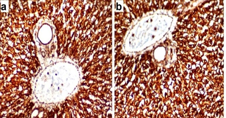 Figure 7: A photomicrograph of a liver section of ACR- treated groups: (a) D1ACR and (b) D21ACR showing marked expression of cytoplasmic immune reaction for caspase 3 of hepatocytes. (Immunoperoxidase technique for caspase 3 X400). EM Examination: Liver section of D1ACR subgroup showed abnormal hepatocyte with indented nucleus, peripheral condensation of chromatin and discontinuous nuclear envelope. The cytoplasm contained abnormally swollen mitochondria, few rough endoplasmic reticulum, lipid droplets, many vacuoles and glycogen granules. Bile can aliculus was dilated. Kupffer cell contained numerous vesicles and lysosomes varying in size and shape in the cytoplasm were found. In D21ACR subgroup, the hepatocytes appeared abnormal with shrunken nucleus and peripheral condensation of chromatin. The cytoplasm contained abnormal shaped elongated mitochondria, rough endoplasmic reticulum and some lipid droplets. Rarefication of the cytoplasm due to destruction of cytoplasmic organelles appeared as electron lucent areas. Bile can aliculus contained few microvilli Figure 8.