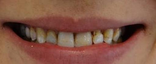 Figure 1: Extra oral view Initial smile.