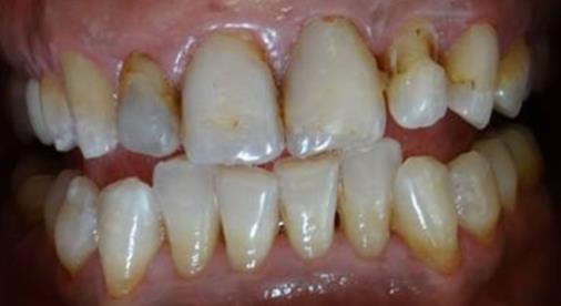 Figure 2: Intra oral view. The dental substance loses important as well as unfavorable occlusal context presented by a deep bite. Therefore, veneers cannot be indicated. Ceramic crows were indicated for maxillary incisors, canines and first premolars, since we need to extend the preparation in the sulcusto cover all the discolored abutment, zirconia crowns were indicated. The preparations needed to be extended in the sulcus to cover all the discolored abutment, zirconia crowns were indicated. The optical behavior of the zirconia systems evaluated is different from the human dentin. Such difference should be taken into consideration to achieve a highly esthetic restoration with a natural appearance [6]. Teeth preparation was done with appropriate instrumentation and a temporary prosthesis was bonded (Figure 3 & 4). Prostheses were fabricated using indirect CAD/CAM technique. Zirconia infrastructure was tried and the space left to the feldspathic ceramic was verified (Figure 5). Esthetic and occlusion relationship were checked and the crowns were seated after ceramic glazing (Figure 6).