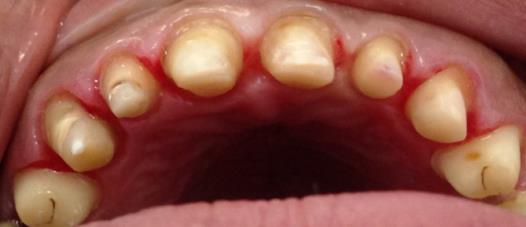 Figure 3: Teeth preparations.
