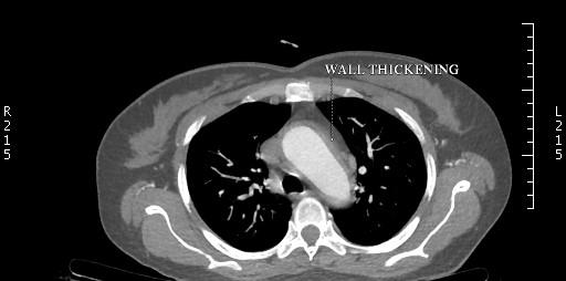 Figure 1: Shows diffuse circumferential wall thickening with adjacent fat inflammation of Arch of aorta.